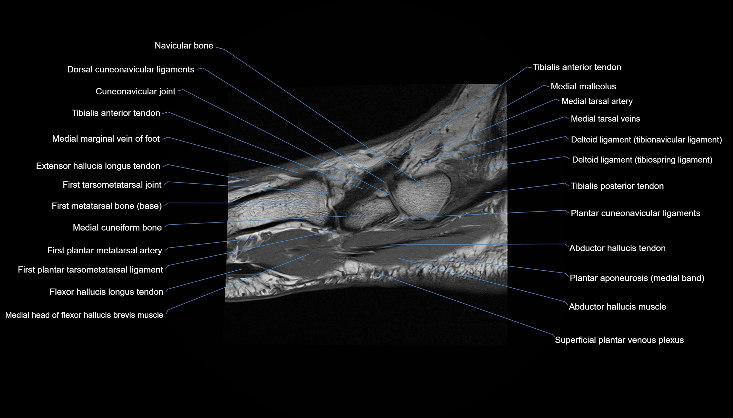 MRI mid foot sagittal cross sectional anatomy 3T  radiology  image-img-00001-00035.webp